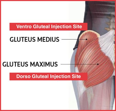 Deltoid Give in the. . Im injection site gluteal